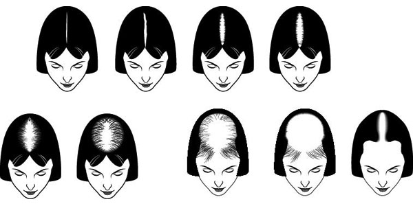 chart of hair loss patterns